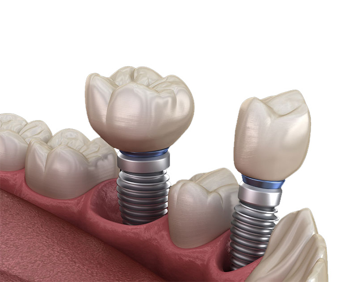 Dental Implants