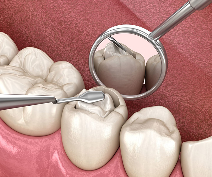 Cavity Filling