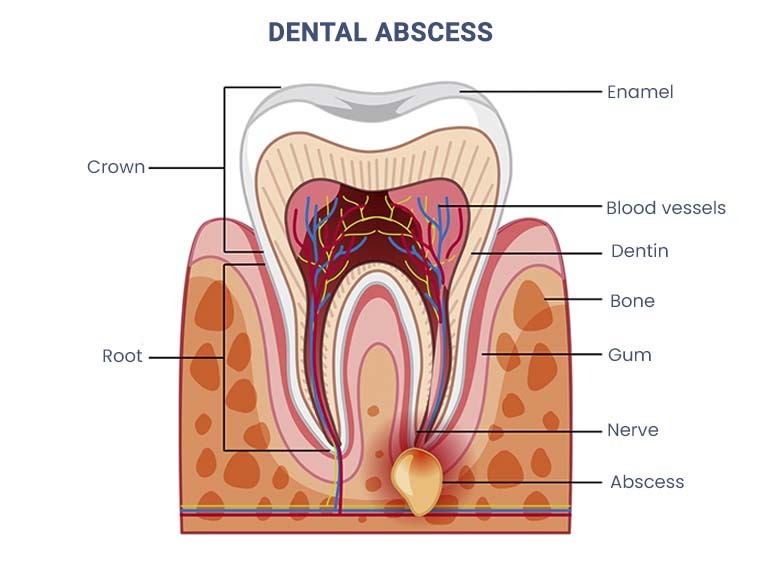 Dental Abscess