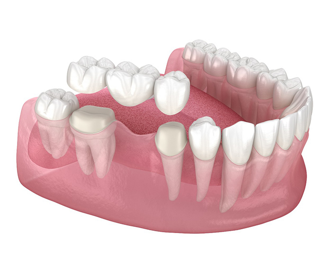 Dental Bridges