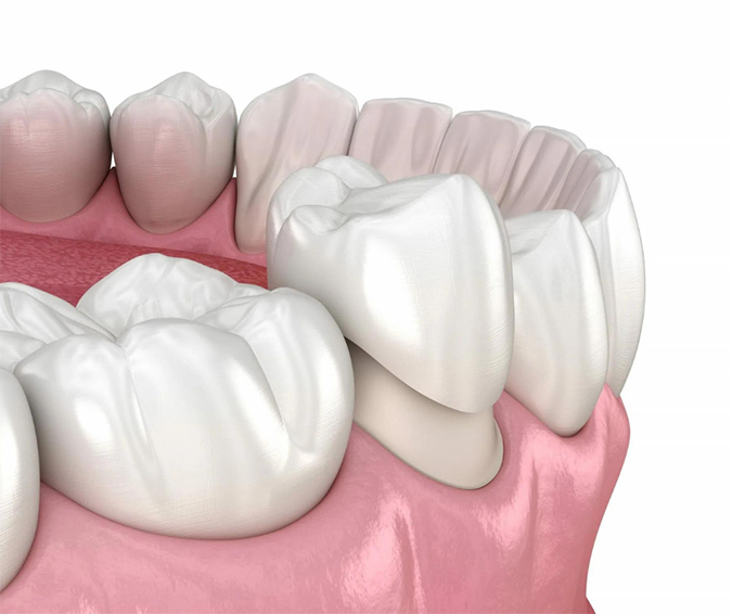 Dental Crowns