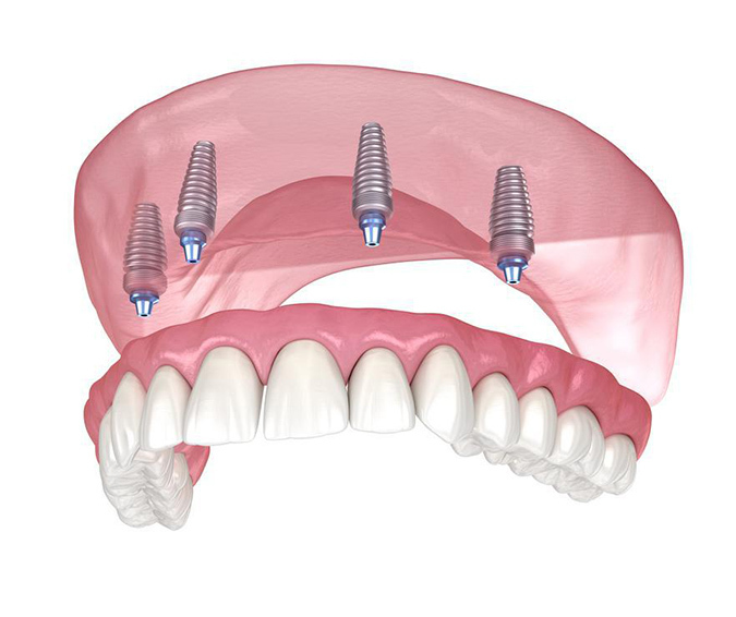 Denture Implants