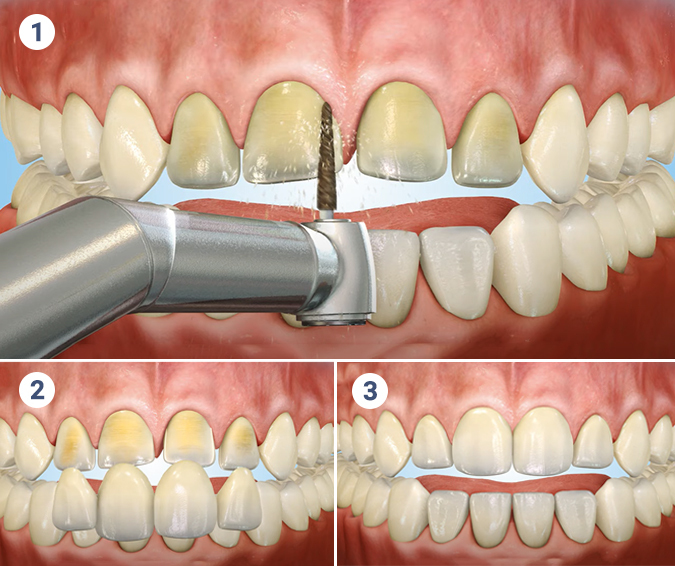 porcelain veneers