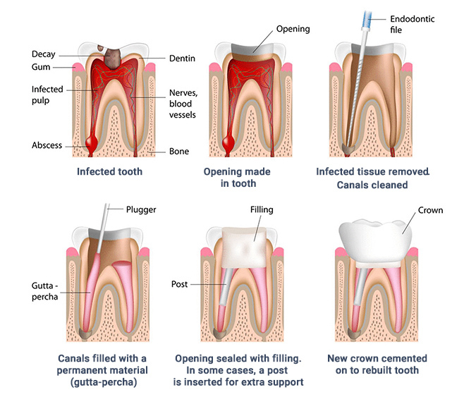 Root Canal Therapy South Huntington NY - Endodontic Treatment