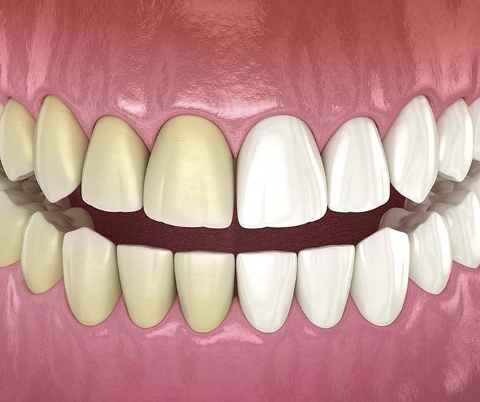 Teeth Whitening
