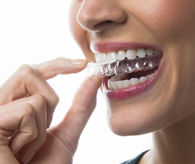 Clear Aligners