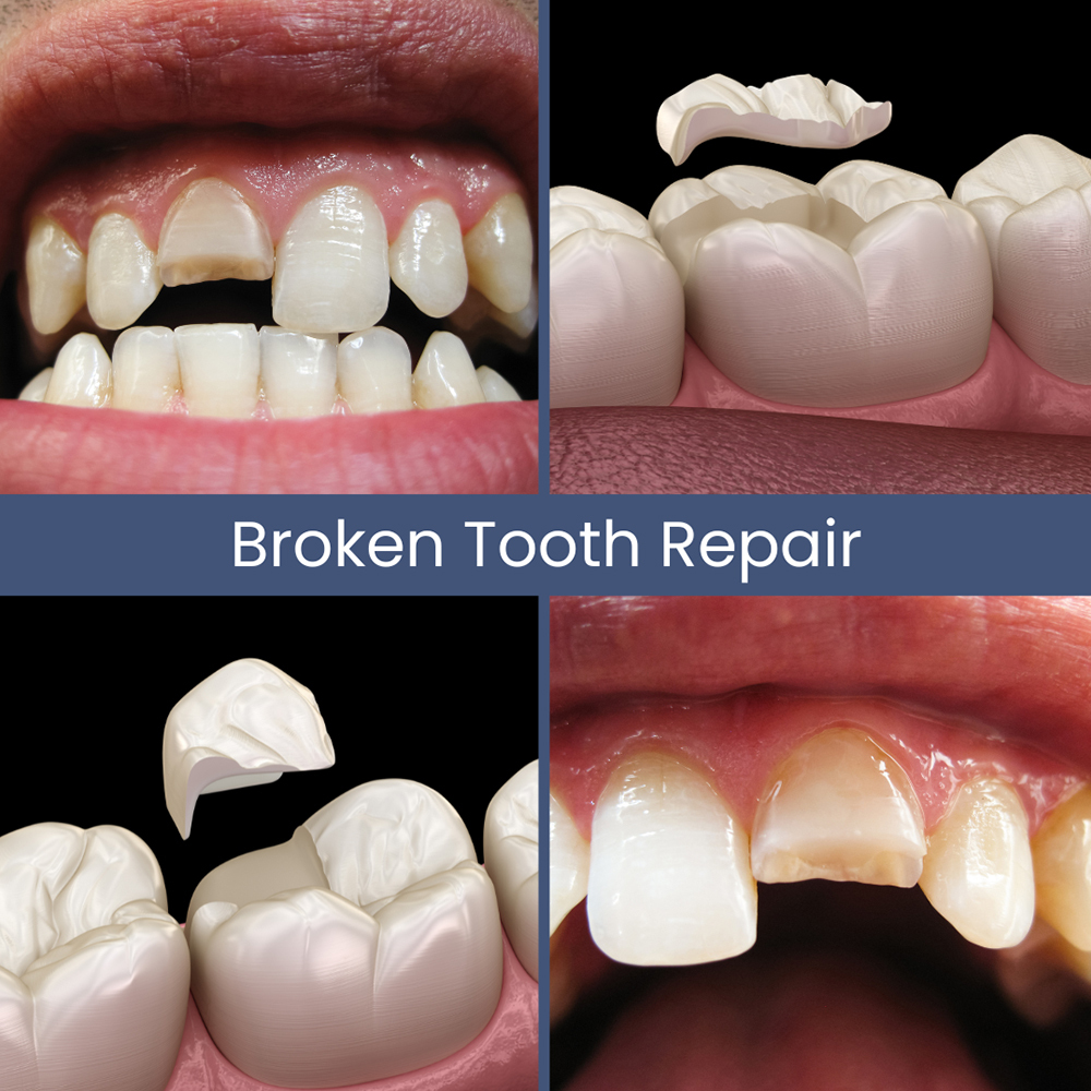 Broken Tooth Repair Cracked Tooth Dentist Rockville Centre, NY