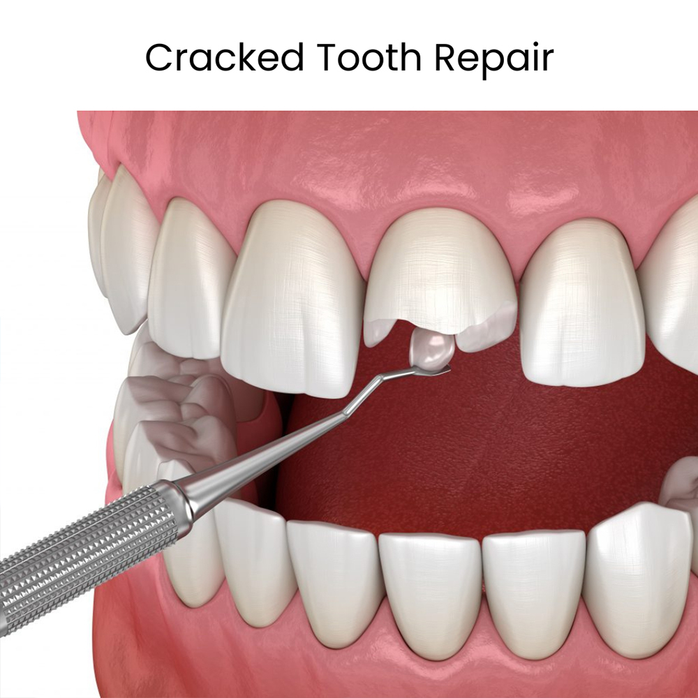 Cracked Tooth Repair