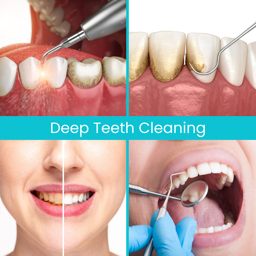 Deep Teeth Cleaning
