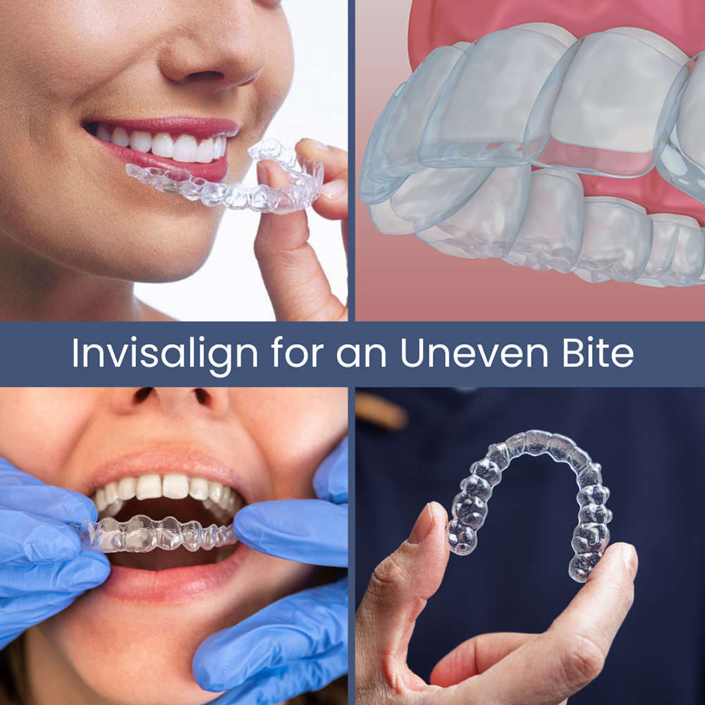 Uneven Bite Invisalign Treatment Rockville Centre, NY Uneven Bite