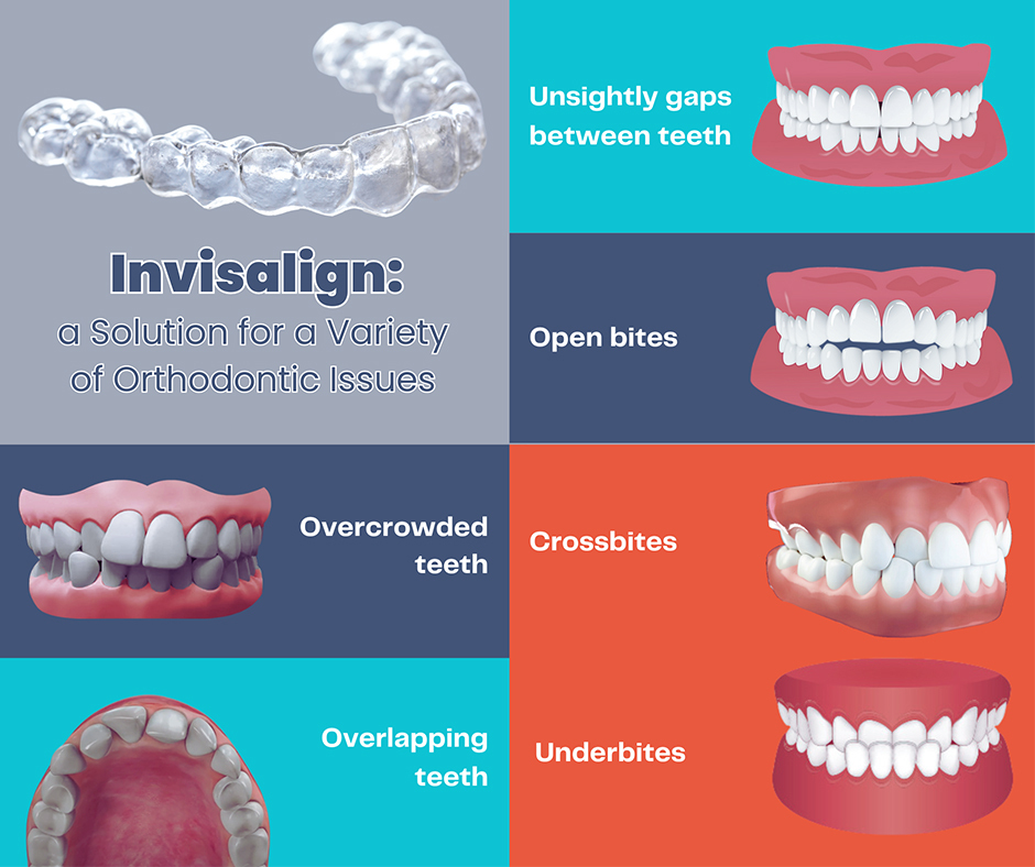 Problems That Can be Addressed by Invisalign