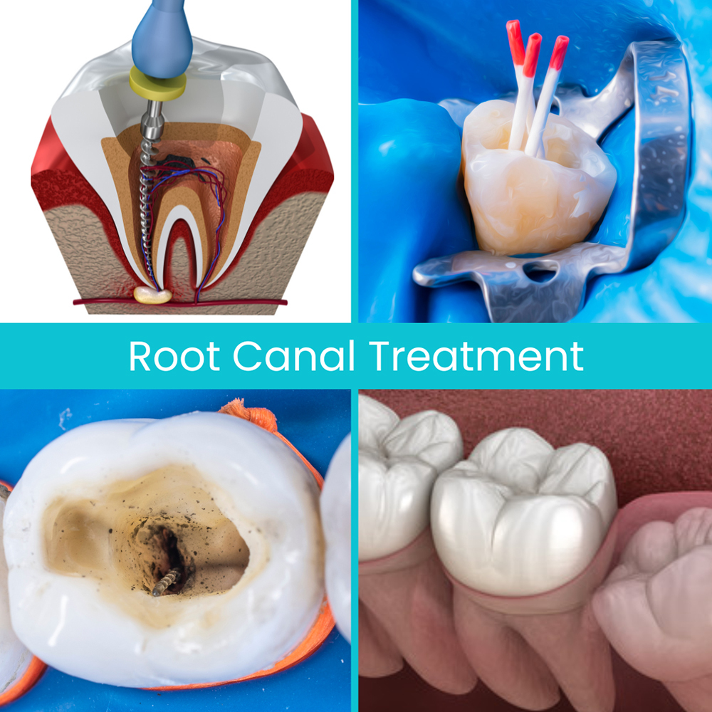 Root Canal Treatment in Rockville Centre, NY Best Endodontist New York