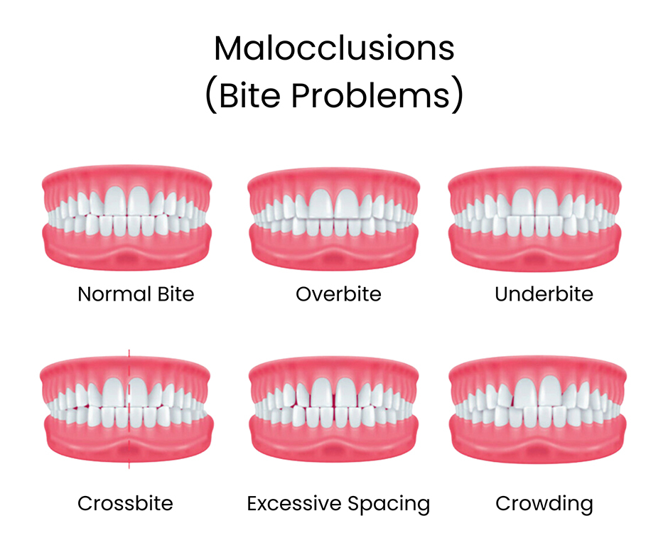 Invisalign for an Overbite  Aligners for Overbite in Rockville Centre, NY